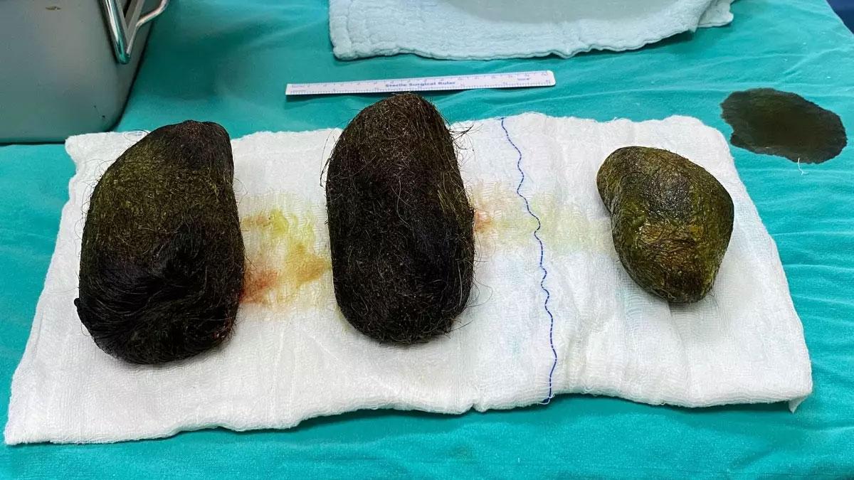 Karın ağrısı şikayetiyle hastaneye başvuran kadının midesinden 2 kilo saç çıktı