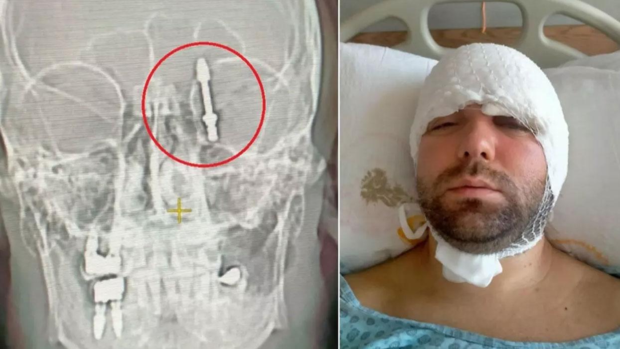 Bursa'da yaşanan inanılmaz olay ABD'de gündem oldu! İmplant tedavisinde vida beyine saplandı