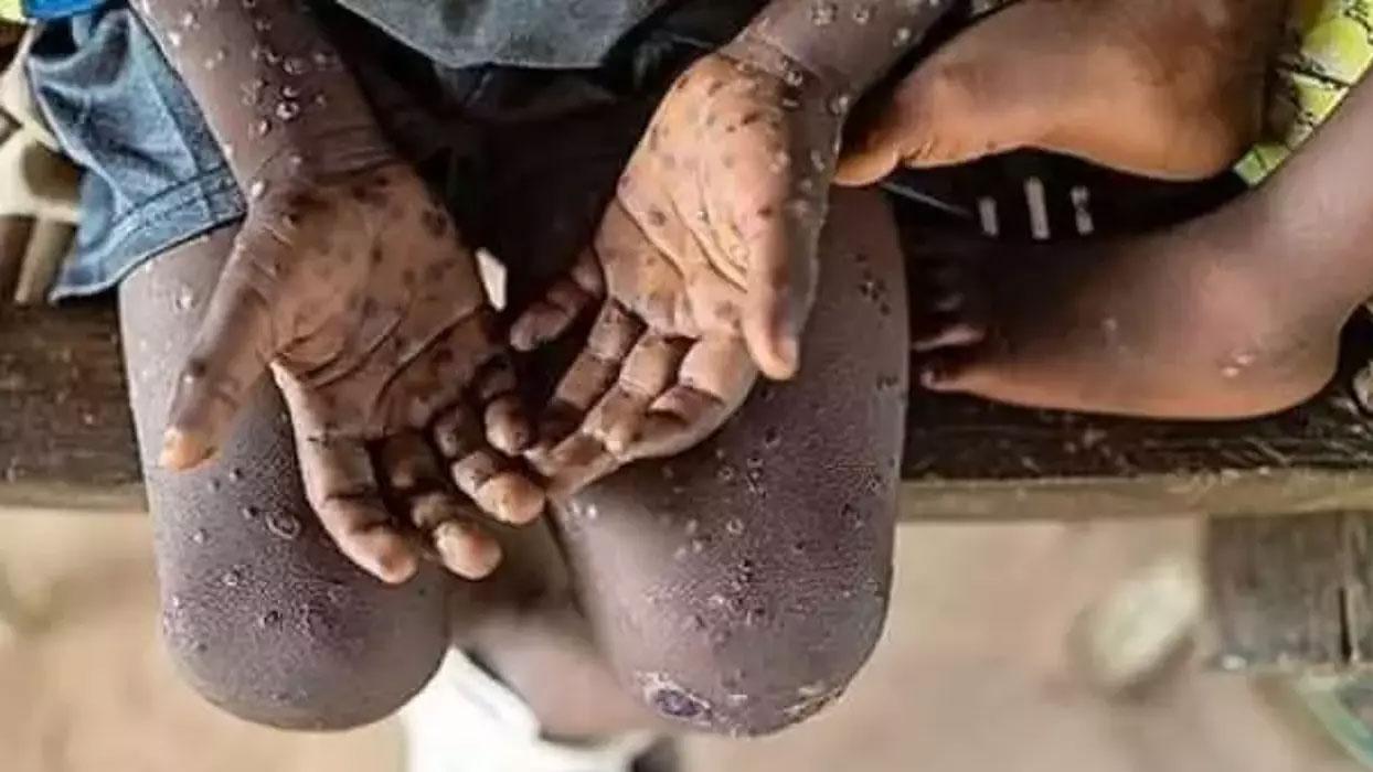 Avrupa, maymun çiçeği salgınından etkilenen ülkelere 215 bin doz aşı bağışladı