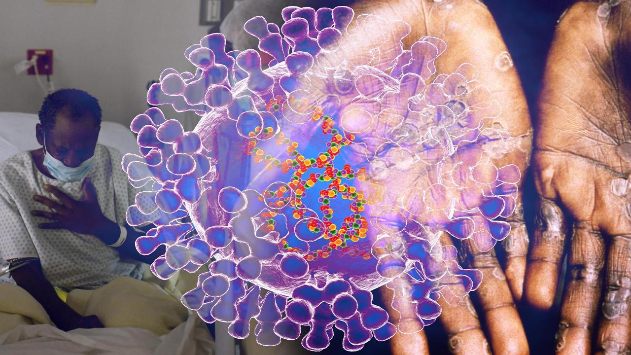 DSÖ' kritik uyarı: Maymun çiçeği virüsü eskisinden daha hızlı yayılıyor