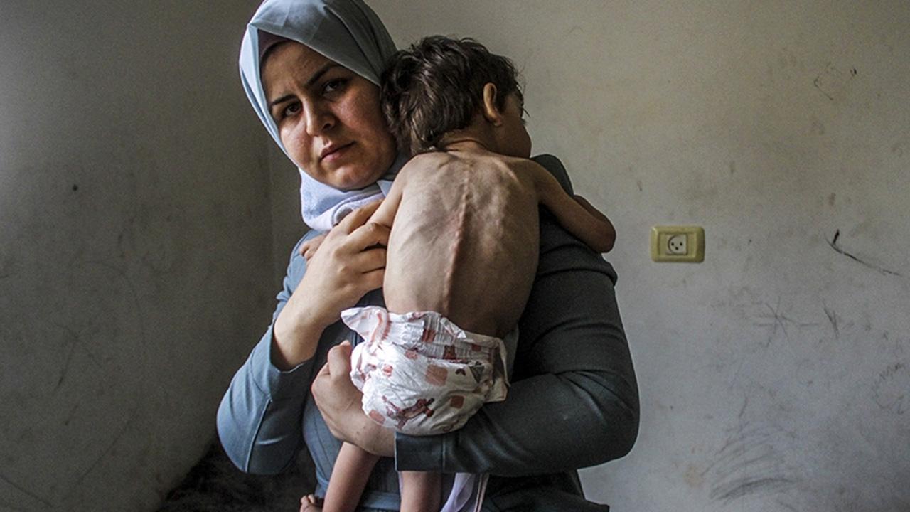Gazze'de çocuklar yetersiz beslenme nedeniyle görme yetilerini kaybediyor
