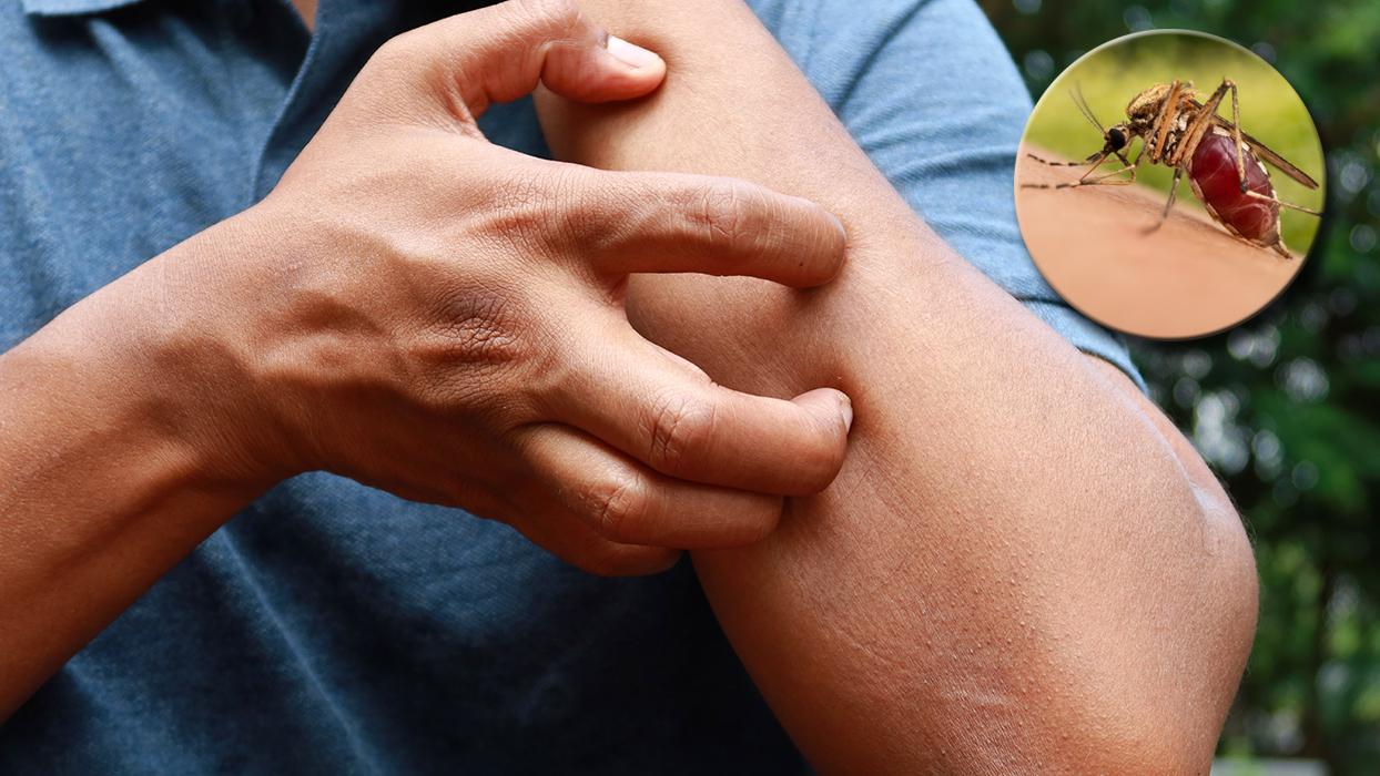 Sivrisinek kaşıntısı şıp diye geçiyor! Meğer çözümü buymuş