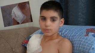 Çarşamba'da köpek saldırısına uğrayan 11 yaşındaki çocuğun hayatı kabusa döndü