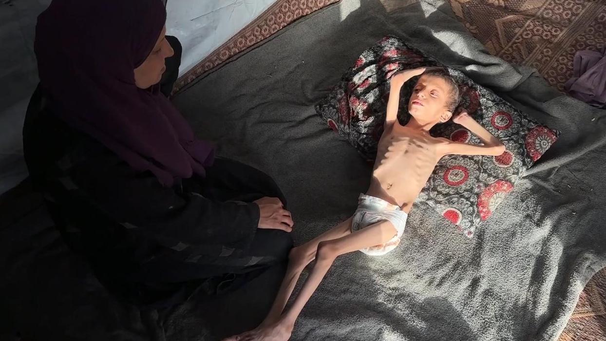 Gazzeli 10 yaşındaki Nafız açlıktan 8 kiloya düştü