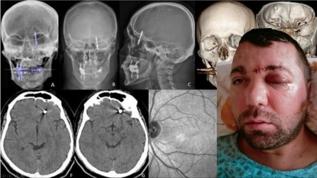 Bursa'da implant faciası! Çene kemiğini delip kafatasına saplandı
