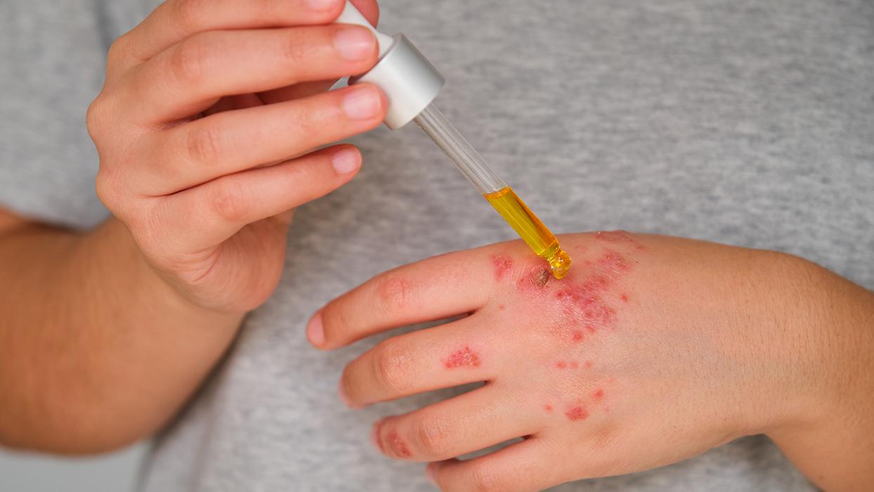 Egzama ve mantarı tek damlasıyla yok ediyor! Cildi parıl parıl parlatıyor, yumuşacık yapıyor