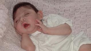 Beyni olmadan yaşayan Alex Simpson'ın 20. yaş mucizesi