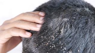 Her gün milyonlarca kişi tüketiyor! Kepek ve egzamanın dostu, cildin düşmanı