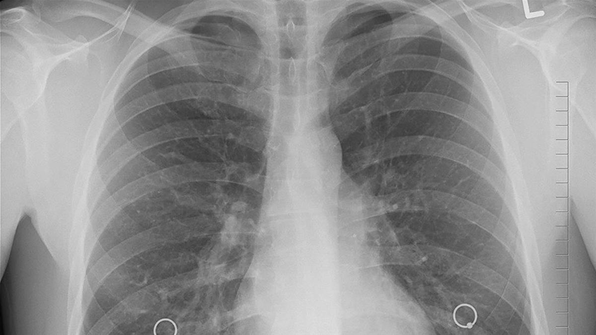 Gizli tehlike: Sigara içmeyenlerde akciğer kanseri neden artıyor?