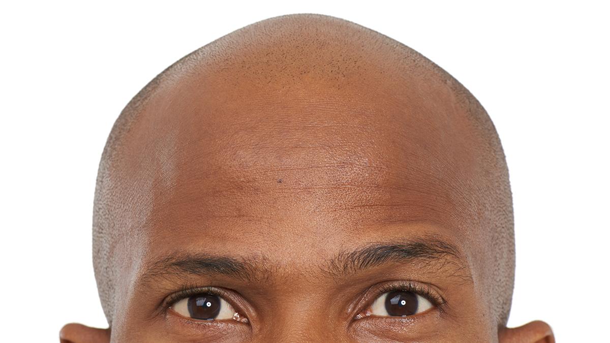 Bilim insanları kelliklerin çözümünü yağ asitlerinde buldu