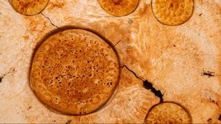 Uzmanlar şaşkın; O kanser türü gençlerde hızla yayılıyor!