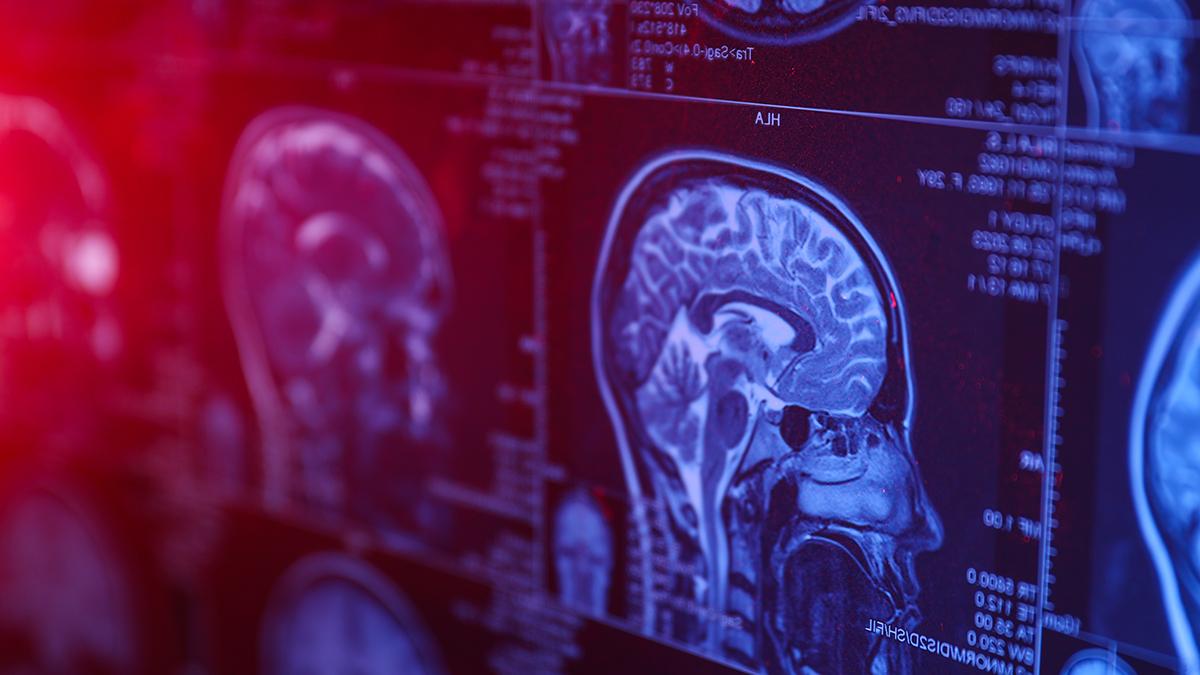 Böbreklerdeki bu işaret beyinde hasar olup olmadığını gösterebilir