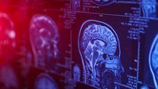 Böbreklerdeki bu işaret beyinde hasar olup olmadığını gösterebilir