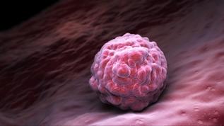 Uzmanlar uyarıyor: Lenf düğümü çıkarımı düşündüğünüzden daha karmaşık olabilir