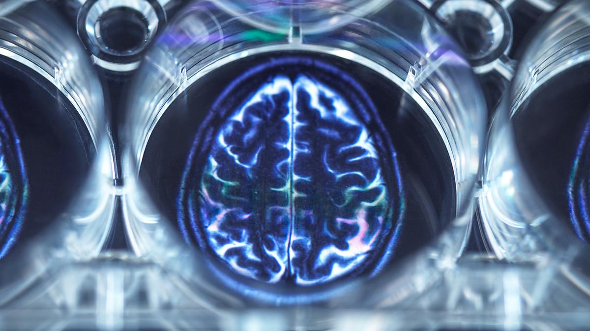 Bilim insanları psikotik bozuklukların ardındaki 'beyin depremi' mekanizmasını ortaya çıkardı