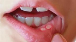 Ağız yaraları aft oluşumu silip atıyor... Ağız yaraları ve aft için öneriler