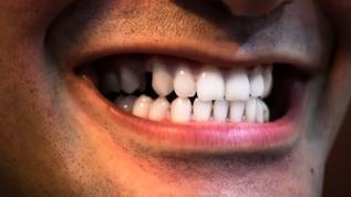 Bu 3 besin dişlerinizi doğal yoldan parlak yapıyor