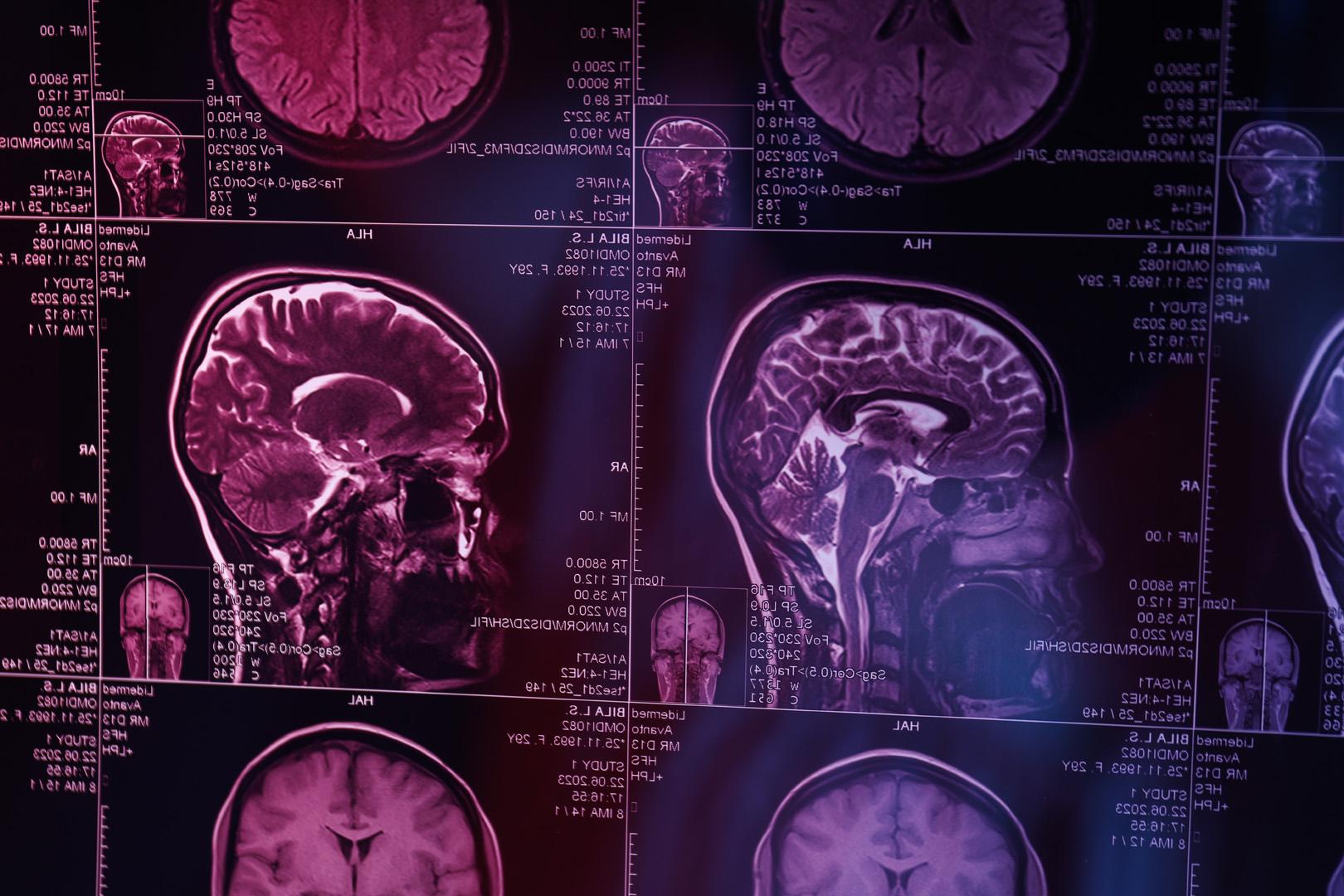 Korkutan açıklama! COVID-19 beyninde kalıcı değişiklikler bırakıyor