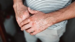 Cilt hastalığının sırrı çözülüyor! Şeker molekülleri psoriasisi tetikliyor