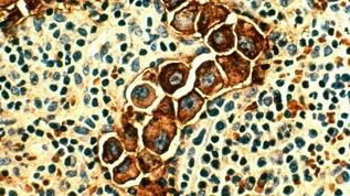 Sessiz iltihap lösemiyi yıllar öncesinden haber veriyor