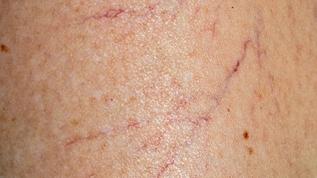 Varis hastalığına karşı evde yapılabilecek basit yöntem nedir?