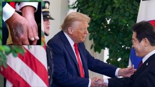 Trump'ın elindeki morluğun sebebi belli oldu