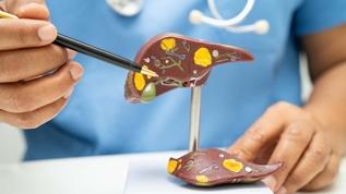 Şaşırtan bulgular! Yağlı diyetin karaciğere verdiği hasar