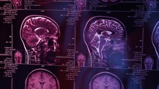 Bilim insanları APOE genini Alzheimer'ın ana nedeni olarak belirledi