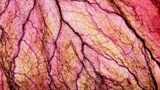 Damar hastalıklarında çığır açan buluş! Bu yöntem hastaların kaderini değiştirebilir