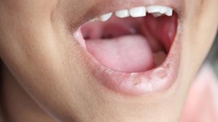 Ağız bakterilerinin gizli dünyası! Diş sağlığında devrim yaratacak keşif