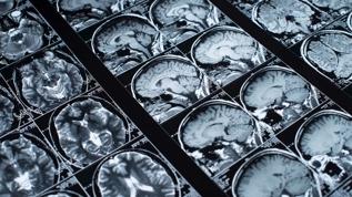 Bilim insanları beyin yaşlanmasını tersine çevirebilecek protein keşfetti