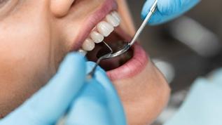 Ağız sağlığınız tehlikede! Diş taşı yanlış biliniyor