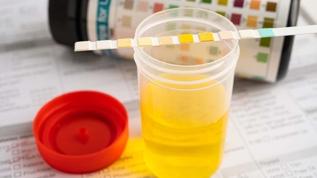 İdrar rengindeki değişiklik hastalık sinyali olabilir