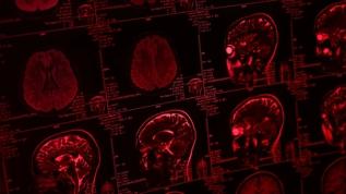 Beyin tümörü tespitinde çığır açan kan testi