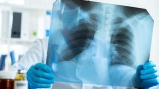 ABD'de 'beyaz veba' uyarısı! Tüberküloz taramaları neden önemli?