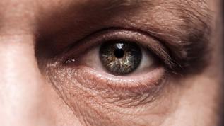 Binlerce hasta körlük riskiyle karşı karşıya! Vitamine A Dulcis krizi büyüyor