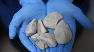 Diyarbakır'da kadın hastadan çıkarılan 6 taş, doktorları şaşırttı