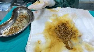 Hastanın ameliyatında 2 bin 67 taş çıkarıldı