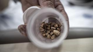 İdrar kanalından 51 taş çıkarıldı