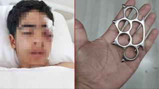 Muştalı akran vahşeti! 15 yaşındaki çocuk bu hale geldi