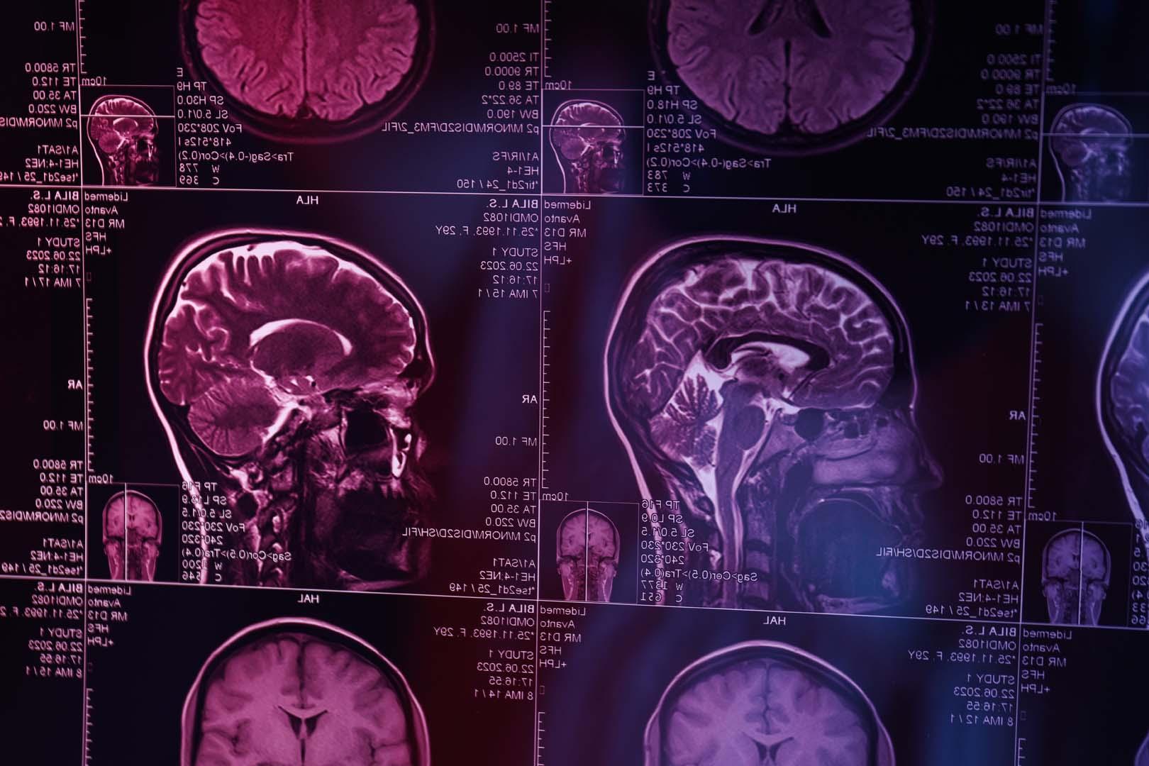 Bilim insanları 50 yaş civarında beyinde başlayan gizli bağışıklık değişimini keşfetti