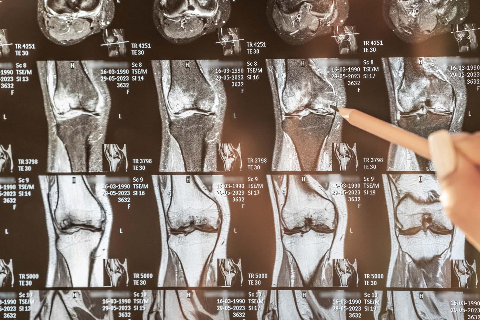 Bilim insanları kemikler için en etkili egzersizleri belirledi