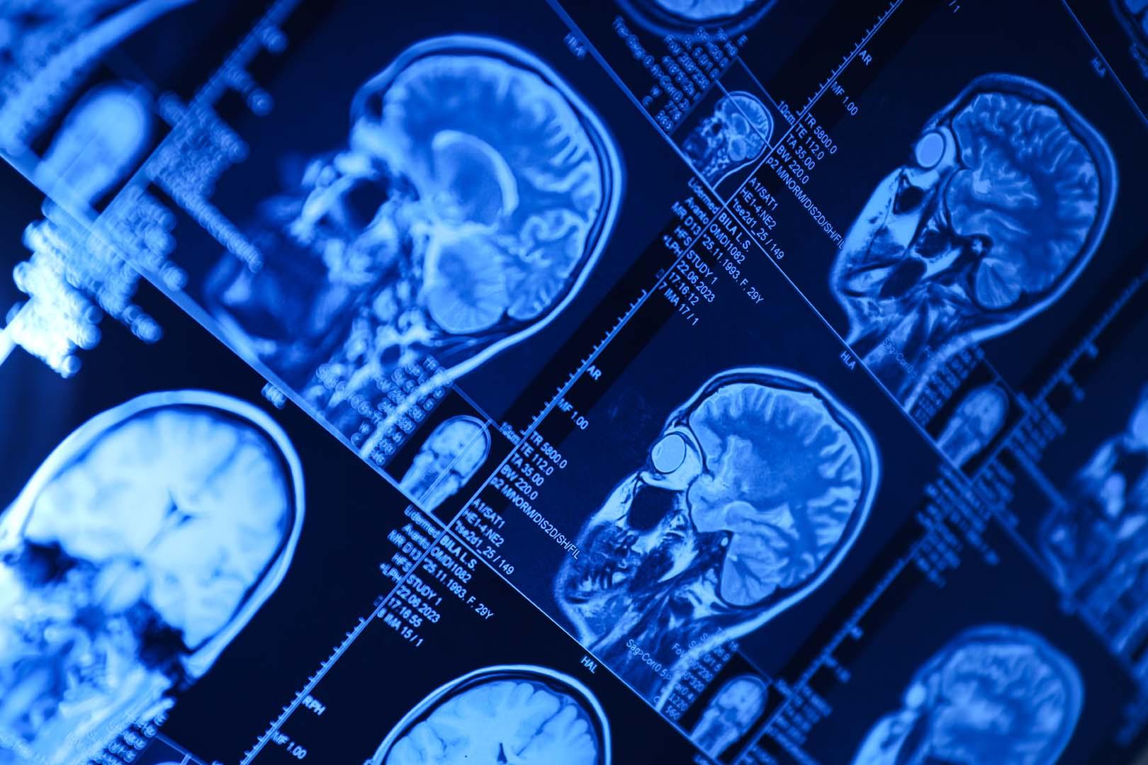 Alzheimer aslında "Tip 3 Diyabet" mi? Bilim dünyasını ikiye bölen "Beyin Diyabeti" hipotezi