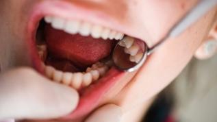 Tıp dünyasında devrim! Saniyeler içinde sürülen sıvı çürüğü anında durduruyor