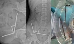 Neredeyse 200 mıknatıs yutan 13 yaşındaki çocuk ölümden döndü