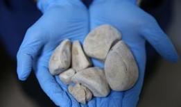 Diyarbakır'da kadın hastadan çıkarılan 6 taş, doktorları şaşırttı