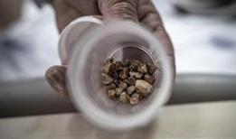 İdrar kanalından 51 taş çıkarıldı