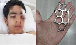 Muştalı akran vahşeti! 15 yaşındaki çocuk bu hale geldi
