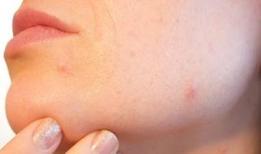 Sadece 2 malzemeyle ciltte mucize: Bu sivilce kürü dikkat çekiyor