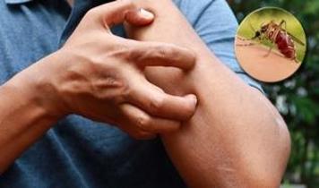 Sivrisinek kaşıntısı şıp diye geçiyor! Meğer çözümü buymuş